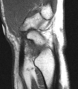 Figure 5 for case trapezial tubercle fracture ( RID2193 )